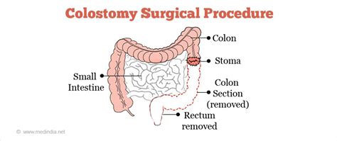 Colorectal Cancer Types Causes Risk Factors Symptoms Diagnosis