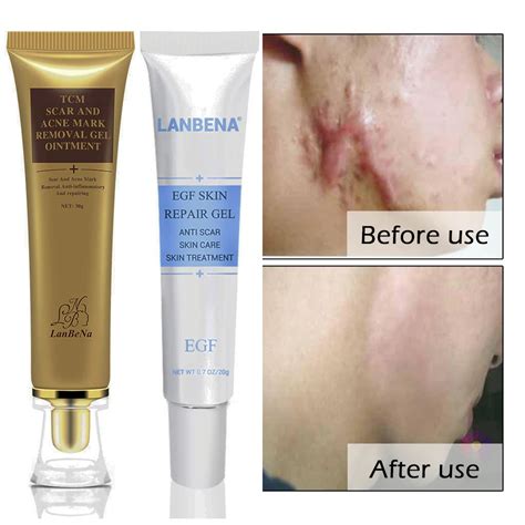 Aliexpress.com : Buy Scar Cream Acne Scar Removal Cream Skin Repair ...