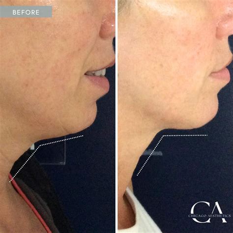 Sofwave Before After Photos Chicago Aesthetics MedSpa