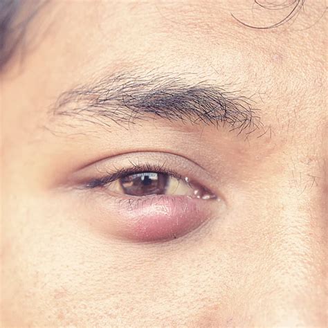 Stye Vs Chalazion Eyefacts