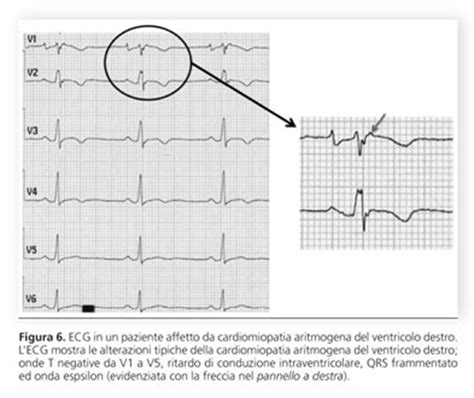 Sindrome Di Brugada Displasia Aritmogena Del Ventricolo Destro