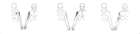 The Localization Of Trigger Points In The Infraspinatus Biceps Brachii