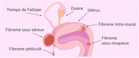 Localisation Des Diff Rents Types De Fibromes
