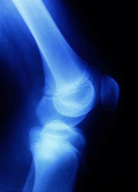 zimmer persona knee implant lawsuits filed due  adverse side effects