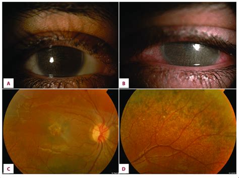 A Follow Up Clinical Photo In The Same Case With Increasing Corneal