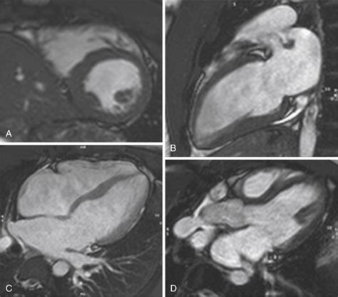 Cardiac Magnetic Resonance Imaging Techniques And Protocols