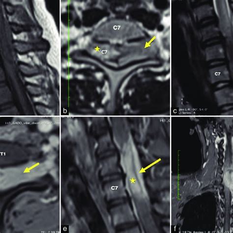 Magnetic Resonance Imaging Of The Cervical Spine Without Gadolinium