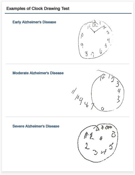 Clock Drawing Test Examples