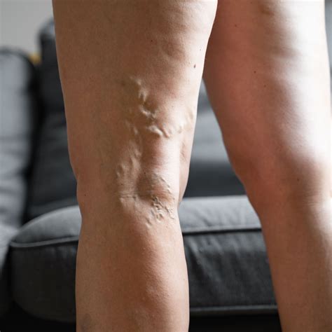 Understanding The Causes And Prevention Of Varicose Veins Vieeye Dubai