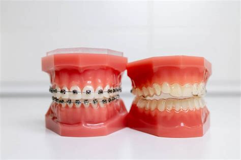 Complete Guide To Pros And Cons Of Invisalign And Braces