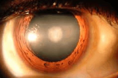 Understanding Cataracts Causes Symptoms And Treatment Options Bulb