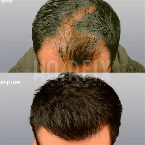 Las Mejores Cl Nicas De Injerto Capilar Para Un Cabello Perfecto