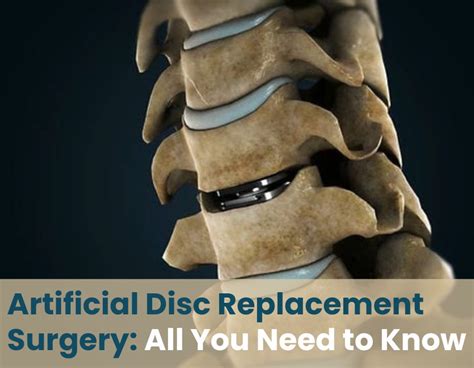 Artificial Disc Replacement Surgery All You Need To Know Orthos Centre