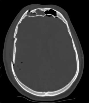 Delayed Tension Pneumocephalus Following Decompressive Craniectomy