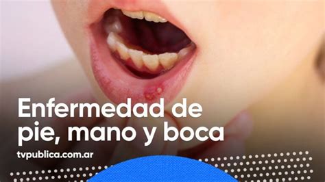 Tratamiento Eficaz Para Lesiones De Mano Pie Y Boca En Niños