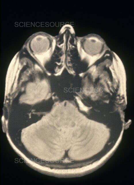 Photograph Mri Of Brain Science Source Images