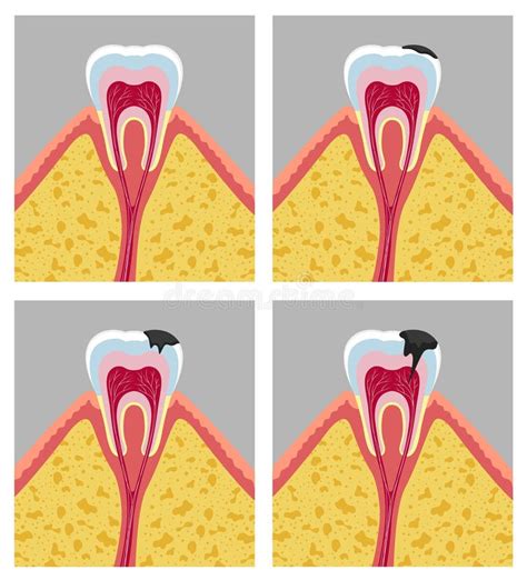 The Stages Of Tooth Decay Flat Vector Illustration No Text Stock