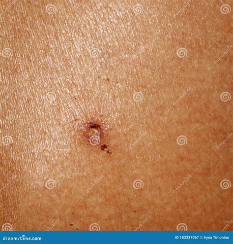 Birthmark Or Papilloma Or Keratopapilloma On Human Skin Closeup Stock
