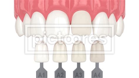 Veneer placement procedure to restore chipped tooth
