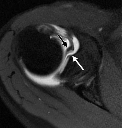 Coracohumeral Ligament Mri