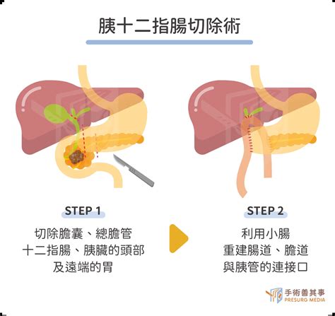 胰臟癌存活率高嗎？罹病原因、症狀、末期治療方式