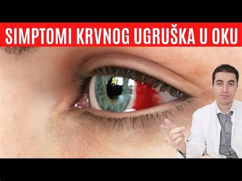 Imate KRVNI UGRUŠAK U OKU Ovako ćete znati YouTube