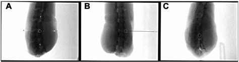 Fluoroscopic Control Images For Correct Needle Positioning Bullseye