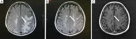 MRI of the brain from July 2020 (A), September 2020 (B), and September ...