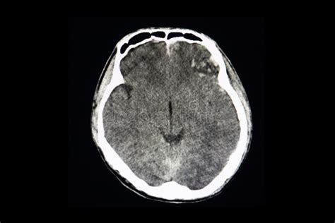 MRI scan of patient brain stock image. Image of resonance - 111820303