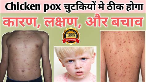 Chicken Pox Chicken Pox Kaise Thik Hota Hai Chicken Pox Kitne Din Tak