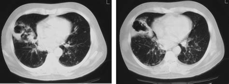 Pulmonary Cryptococcosis Appearances In Chest Computed Tomography Scans Download Scientific