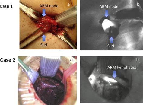 Feasibility Study Of Axillary Reverse Mapping For Patients With