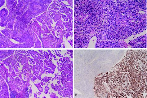 A Lymph Node Metastasis Revealing 2 Different Histological Patterns Download Scientific