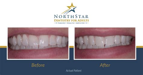 Dental Bonding Before and After (Real Patient's Story!)