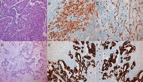 Pathological features of the liver tumor. The tumor displayed 2 ...