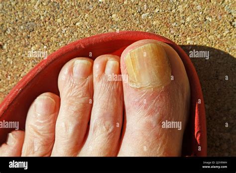 Toenail Fungus Foot Great Toe Close Up Medical Condition Disease