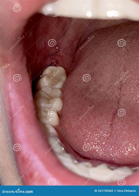 Soft Focus Sutures After Wisdom Tooth Extraction Dental Surgery Stock