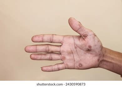 Close Secondary Stage Syphilis Sores Lesions Stock Photo 2430590873