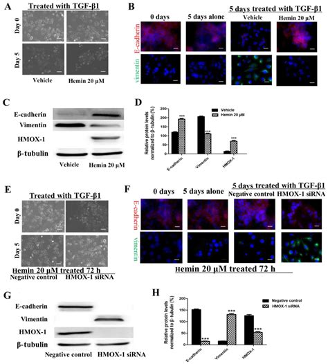 HMOX 1 inhibits TGF β induced epithelial mesenchymal transition in the