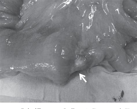 Figure 2 From A Case Of Adenocarcinoma Of Aberrant Pancreas In The