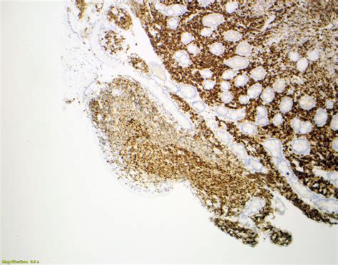 Pathology Outlines Follicular Lymphoma Duodenal Type