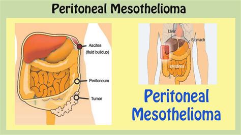 loihealth: Peritoneal Mesothelioma Symptoms of Peritoneal Mesothelioma ...