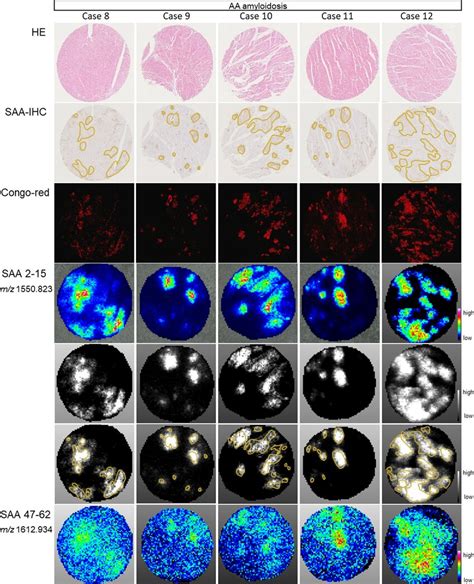 Saa Specifically Localized To Amyloid Deposits In Validation