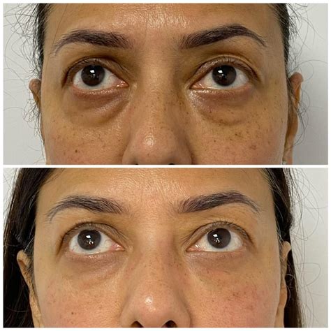 Tear Trough Treatment Solutions To Improve Dark Circles And Hollowness