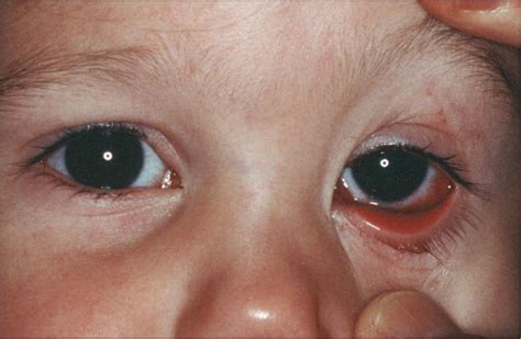 6 Things to Know About Conjunctivitis in Children (pink eye) – Page 2 ...