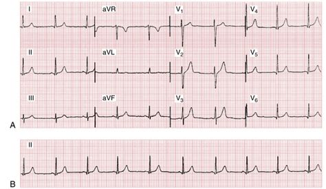 ECG Leads | Thoracic Key