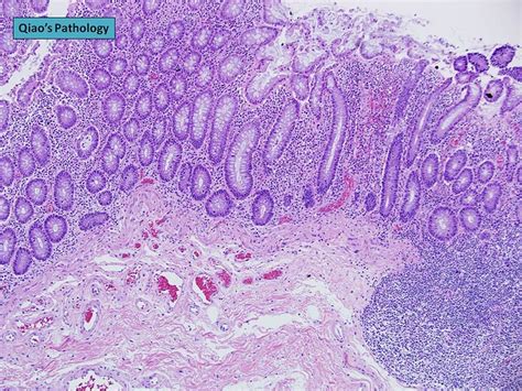 Qiao S Pathology Angiodysplasia Of The Colon A Photo On Flickriver