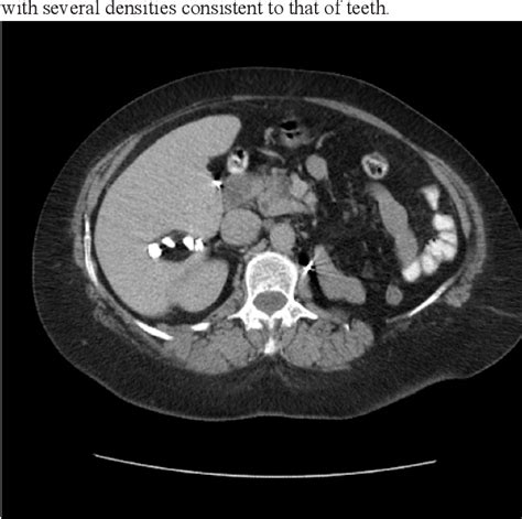 PDF Primary Mature Cystic Teratoma Of The Liver Report Of A Rare