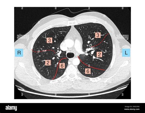 Illustration Of The Lungs Pulmonary Segmentation In Thoracic Ct This