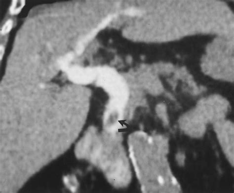 Diagnosing Bile Duct Stones Comparison Of Unenhanced Helical Ct Oral